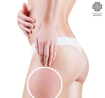 ANÁLISIS DE TIPO DE CELULITIS ANÁLISIS DE TIPO DE CELULITIS